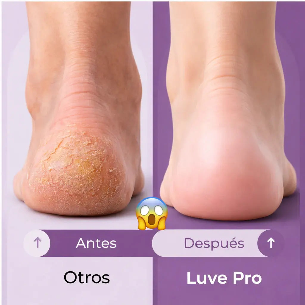 Elimina callos y recupera la suavidad de tus pies con Luve Pro